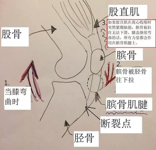 很多文章翻译有误,这是完全不同的软组织),最关腱的肌肉就是股直肌(与