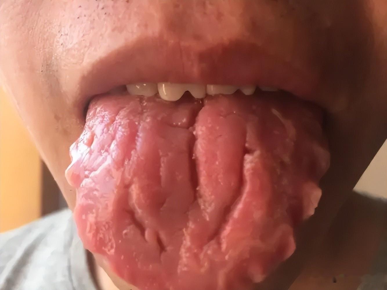舌头上有裂纹咋回事,一个方子解决舌头上的裂纹 