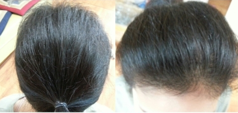 30岁女性头顶脱发5000毛移植恢复效果
