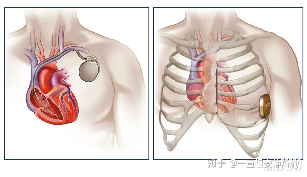 全新一代全皮下植入式心脏除颤器sicd