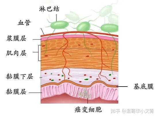 我们以大肠的原位癌为例如果癌变的细胞局限于黏膜层没有穿过基底膜