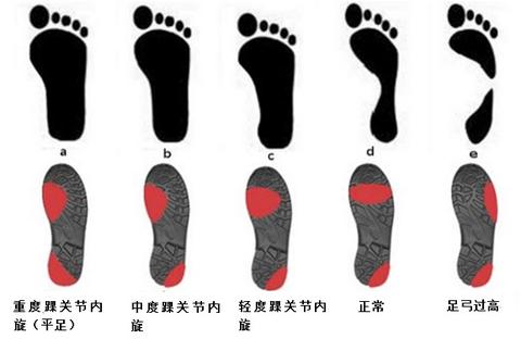 外八字 扁平足问题 踝关节内旋自检与改善方法 知乎