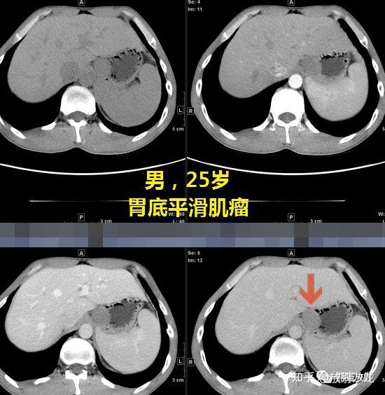如何用CT区分：胃间质瘤和胃神经鞘瘤 - 知乎