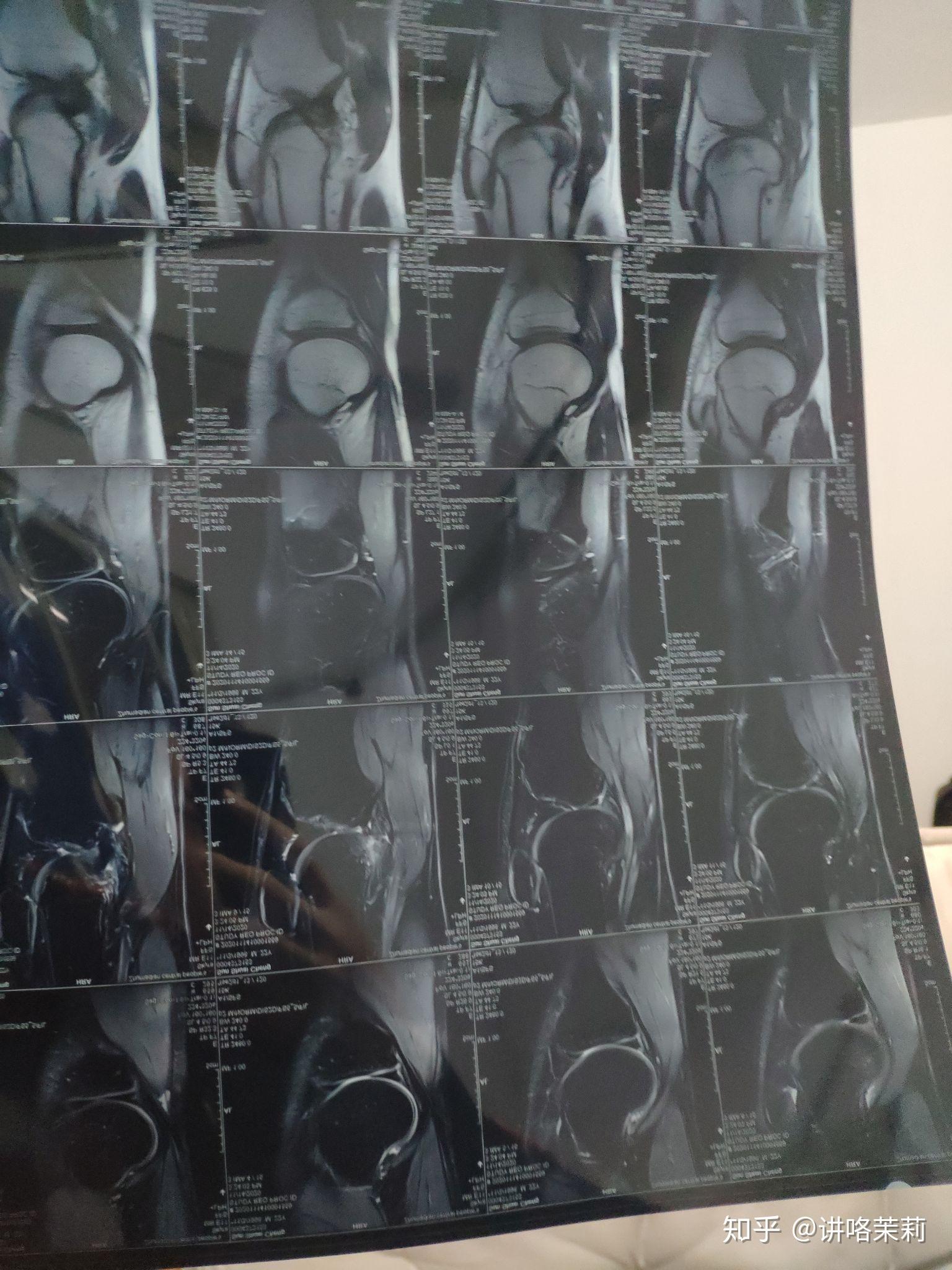 半月板后角变性怎么康复训练,目前不能下蹲,走路有点疼 - 知乎