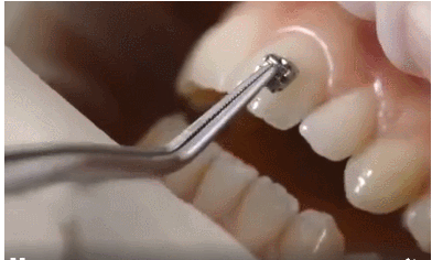 牙套是怎么粘在牙齿上的粘牙套的全过程