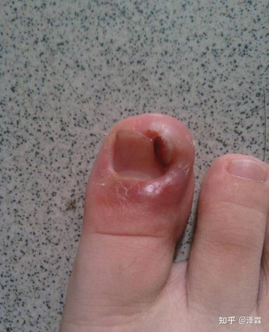 首先要知道什么是甲沟炎?