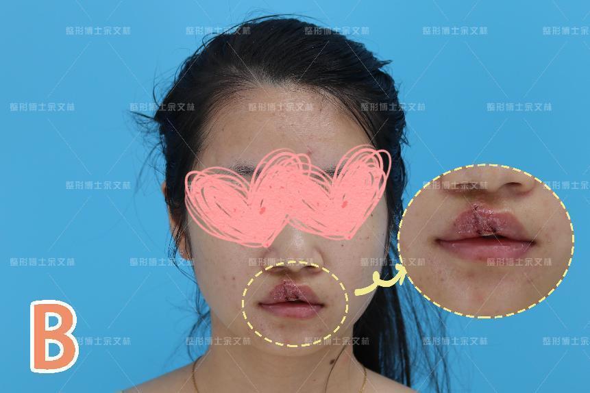 【案例分析】26岁女子唇裂术后唇红缘不齐,术后2个月效果良好 - 知乎