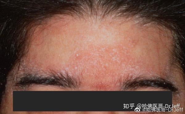 头皮屑和脂溢性皮炎如何治疗 - 知乎