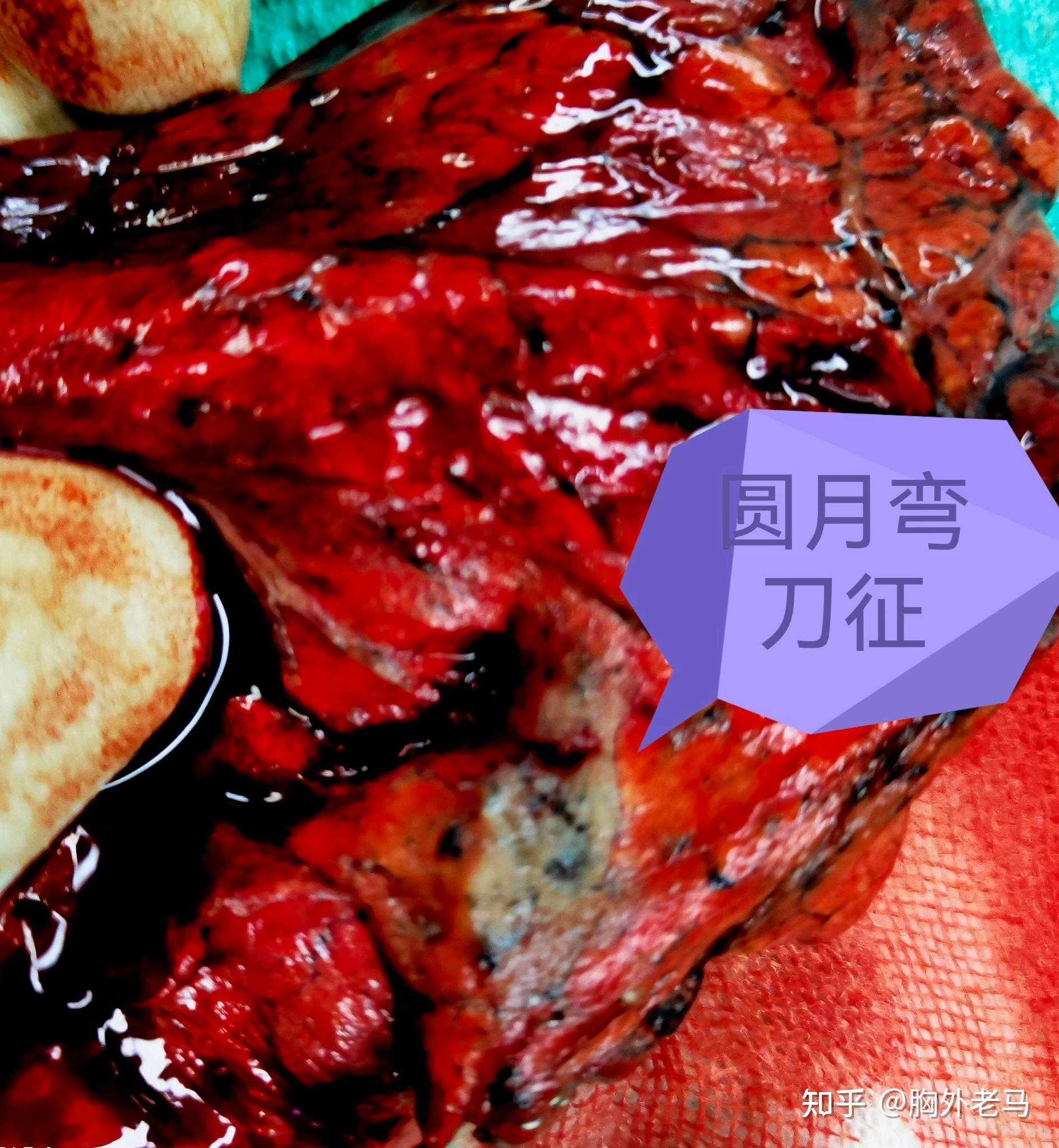 圆月弯刀征又一例