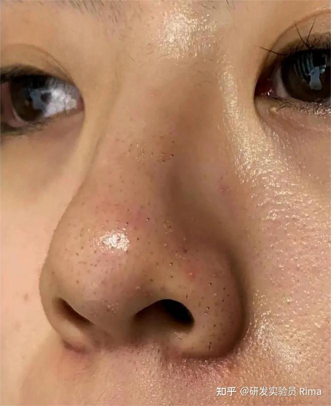 痘痘,黑头,闭口,油光统统拿捏~ - 知乎