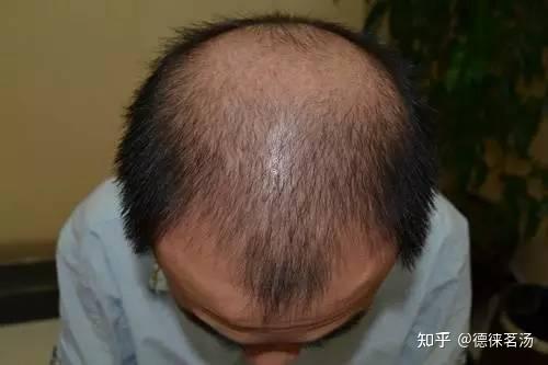护发素对头皮的伤害有多大