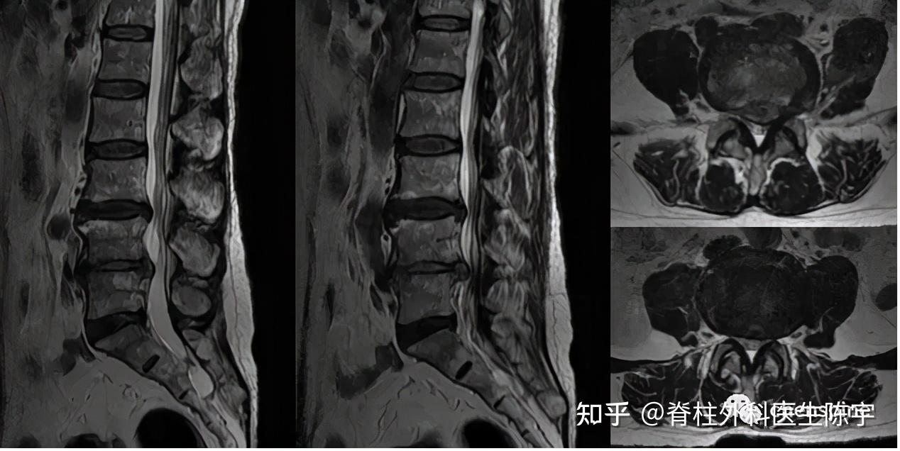 侧隐窝mri示意图图片