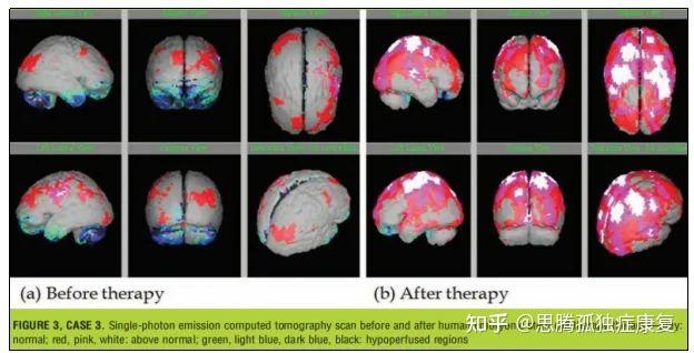 思騰海外關注美國幹細胞療法實驗新成果3名孤獨症兒童的認知言語情緒