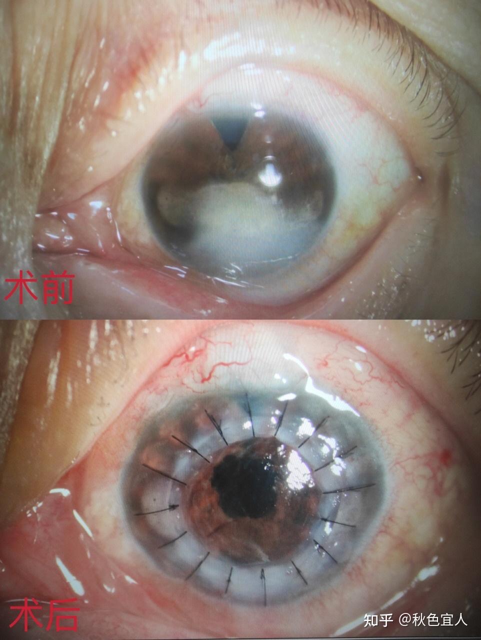 角膜白斑引起的看东西模糊,继发性眼红,眼胀甚至失明等,是放弃治疗