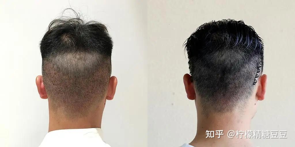 aht植发视频(aht植发技术多少钱)