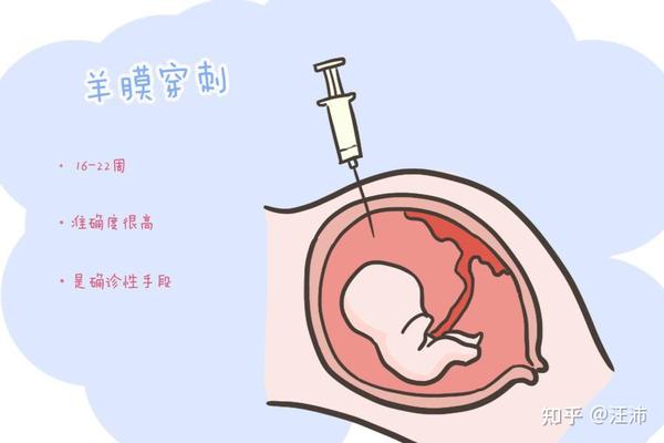 孕期日记 二 做羊水穿刺都经历了什么 知乎