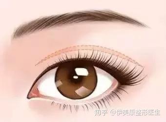 怎么改变内双眼皮 v2-748f8d81346d24bfdbbc1aa65691561b_b.jpg