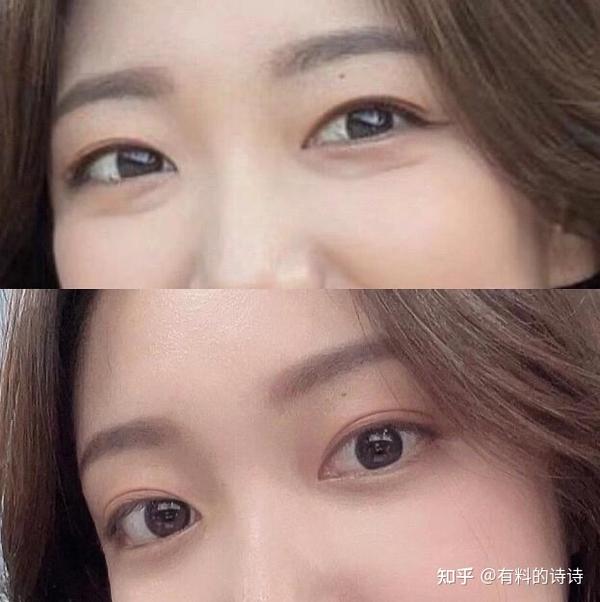 0|双眼皮已就位!各城市双眼皮医生