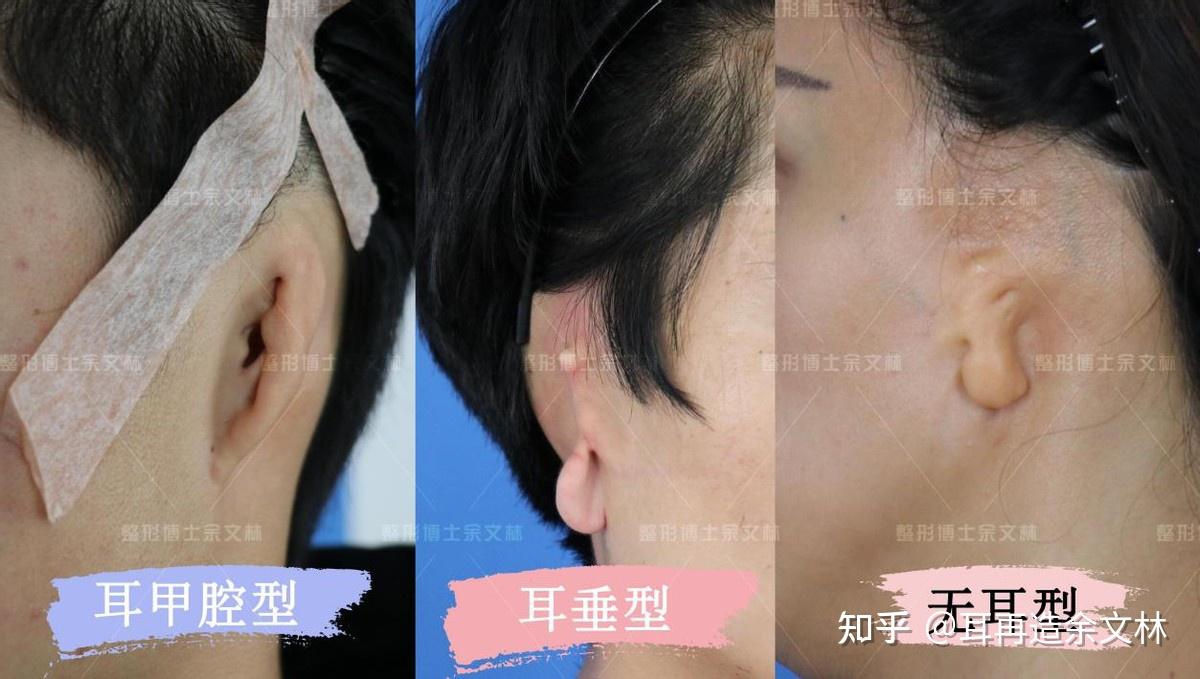 甲腔也是耳朵比较重要的亚结构之一,正常的耳甲腔有一定的深度和大小