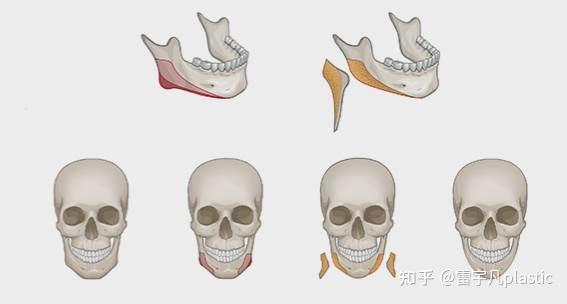 剩余一直到颏部,做一个长曲线的整体切除,得出的下颌