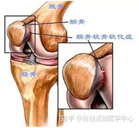 跑步后膝盖疼,怎么恢复?