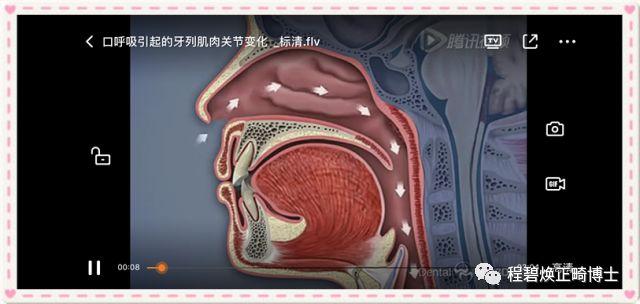 組圖解釋口呼吸的形成過程:腺樣體不肥大時鼻腔通氣正常腺樣體肥大