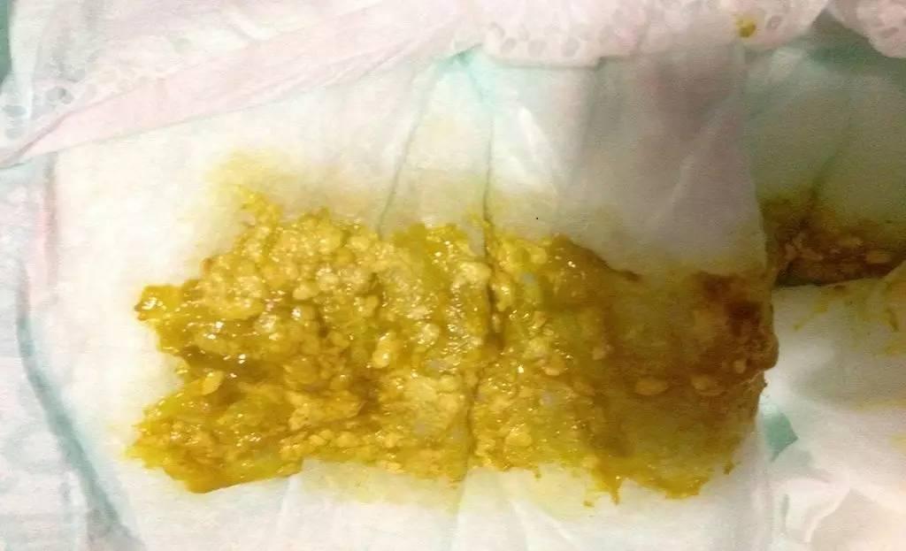 13种宝宝便便大集合,判断便便正常与否月嫂收藏这篇就够了(图片刺激