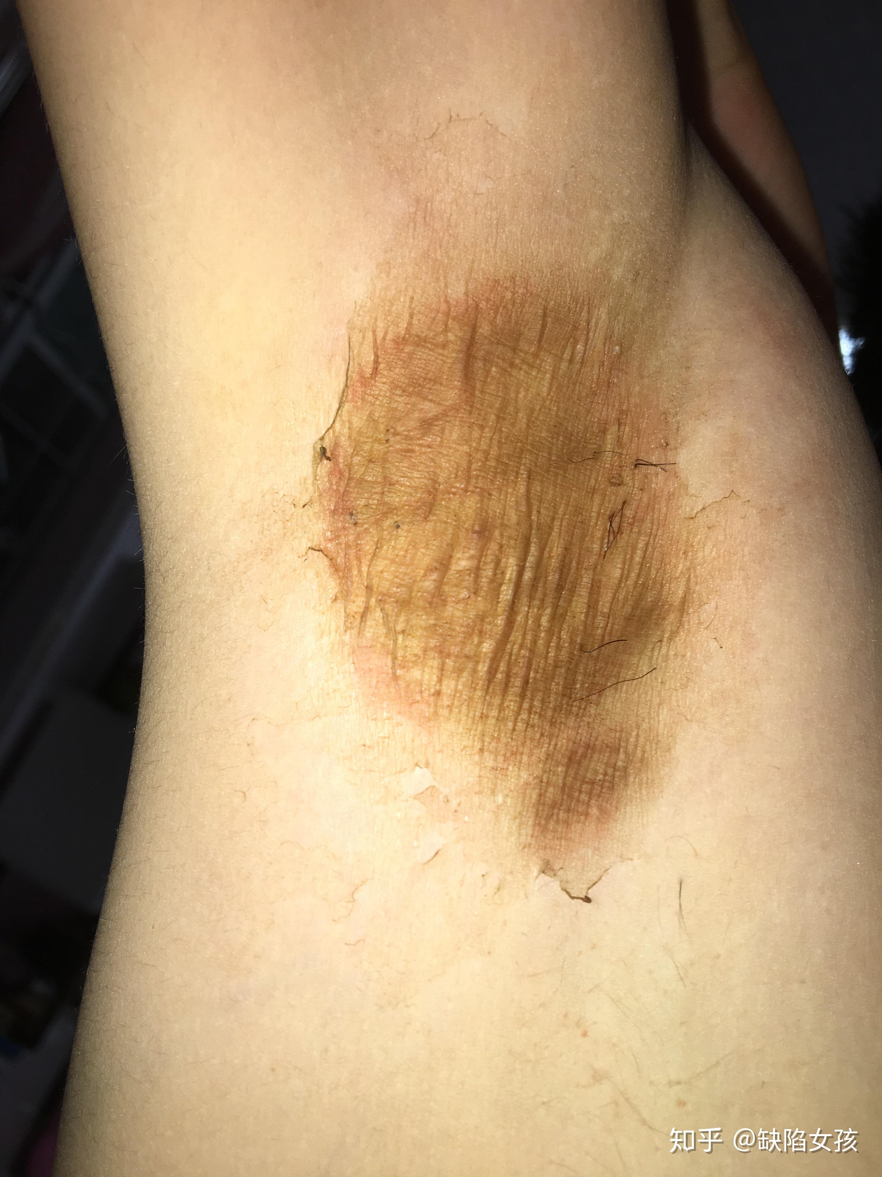 腋臭手术疤痕(微创)持续更新