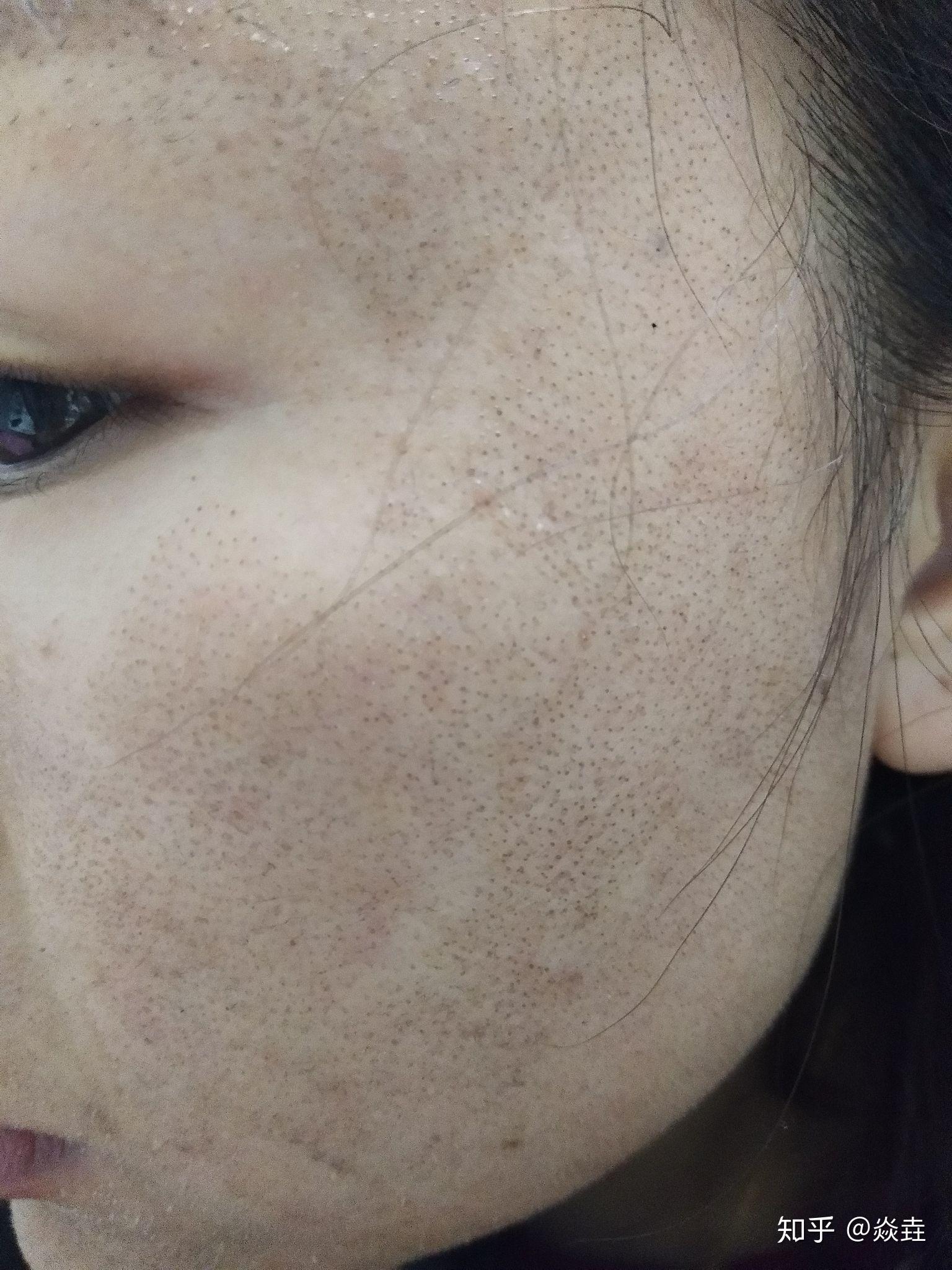 在医院治好痘痘,炎症好了,再做激光