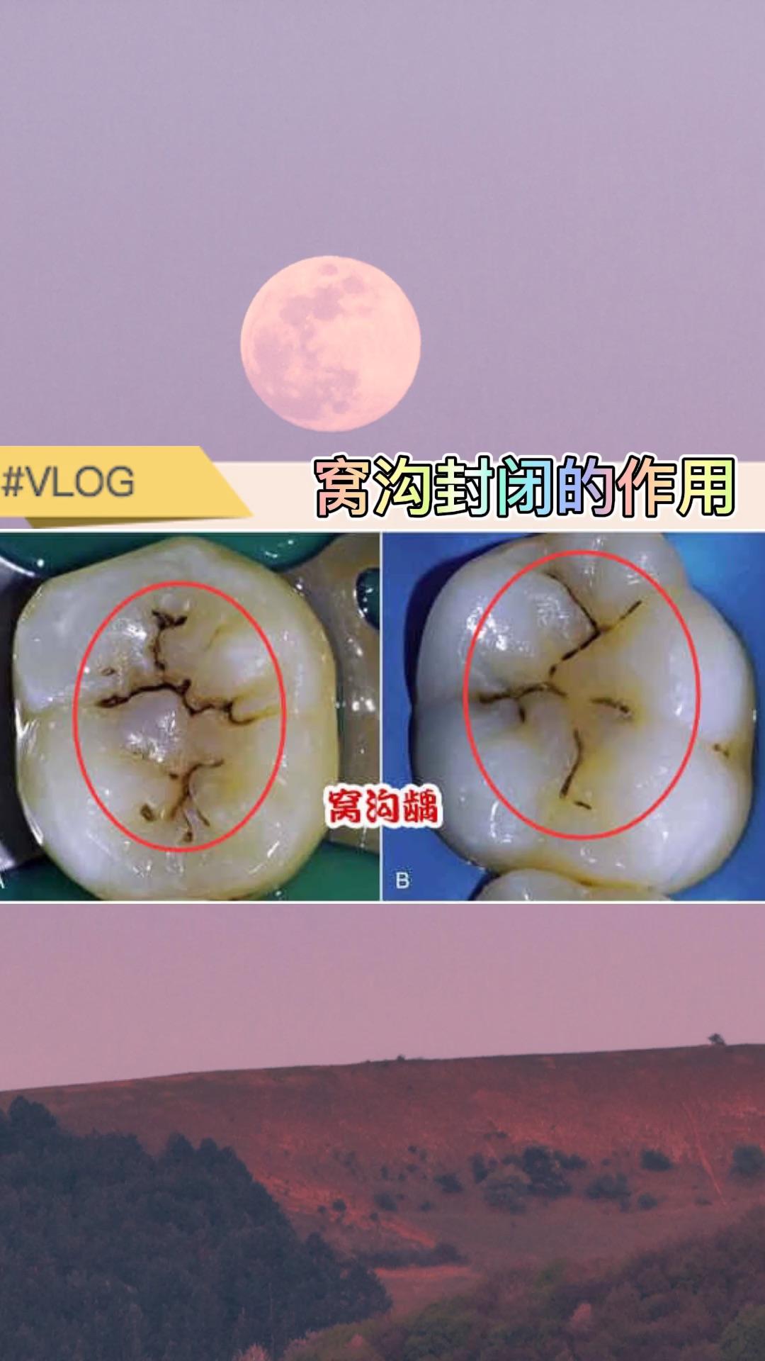 学校组织的窝沟封闭是什么?