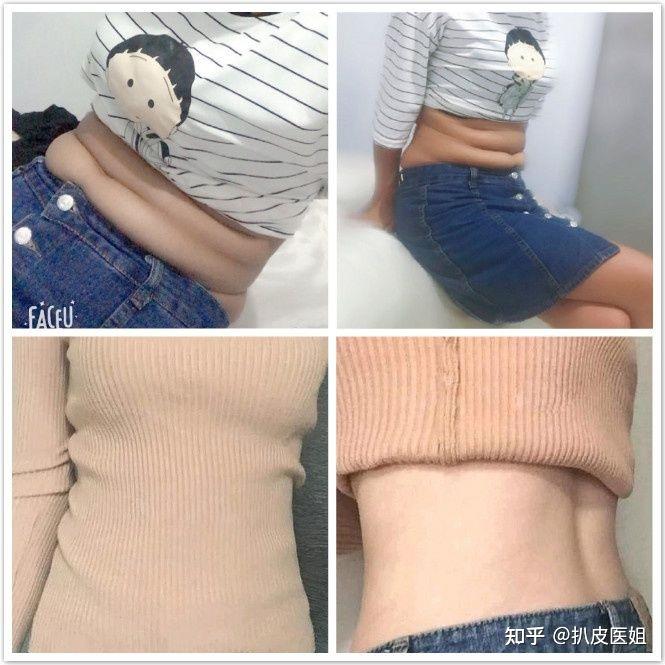 成都吸脂填充有哪些靠谱的医院医生多少钱