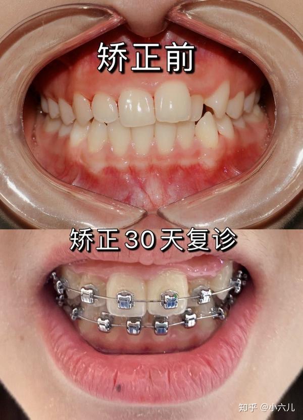 矫正复诊，自锁金属1.2w - 知乎