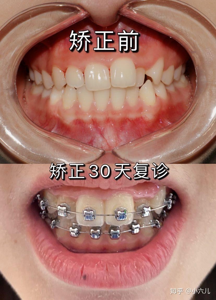矫正复诊,自锁金属1.2w - 知乎