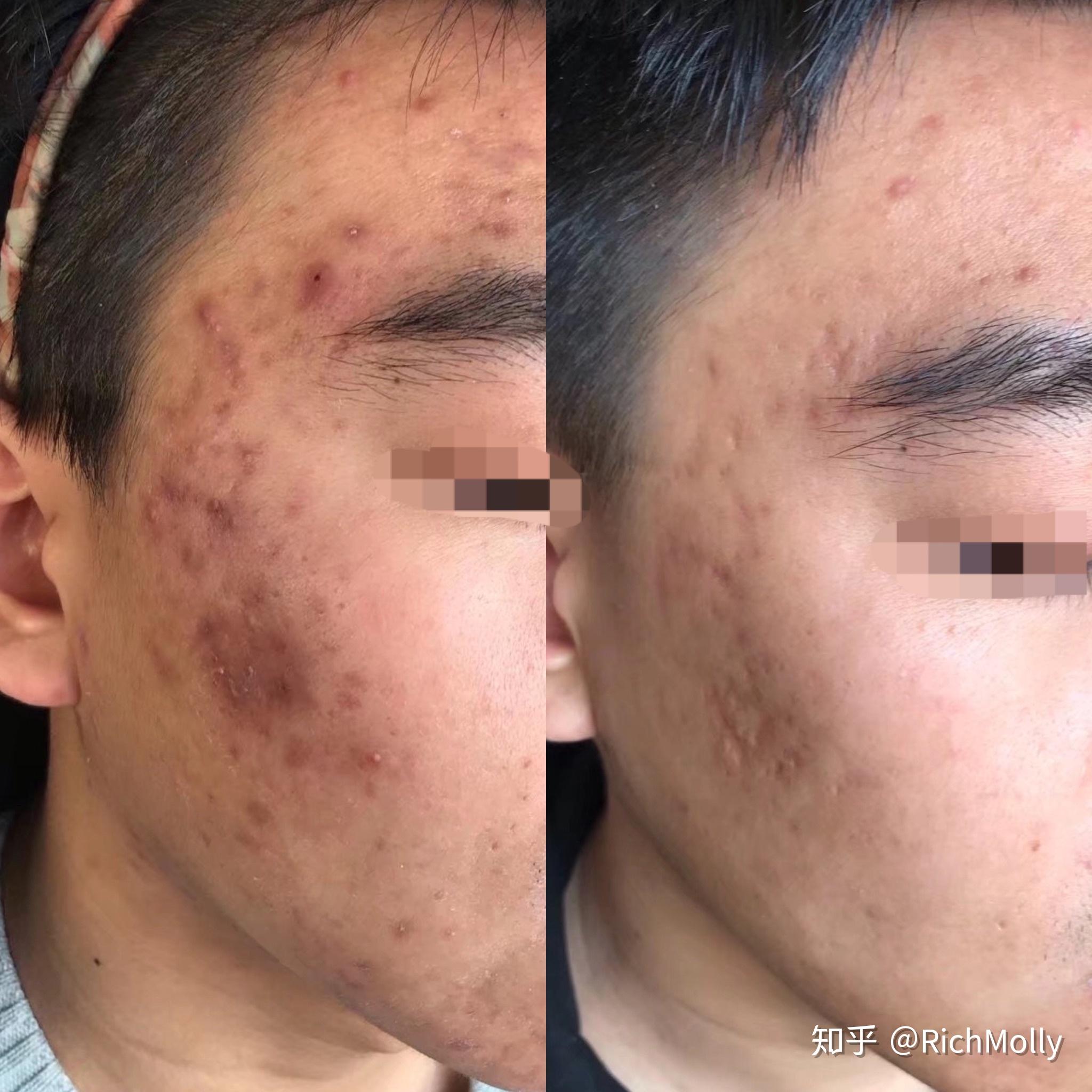 一个人痘没了颜值有多开挂