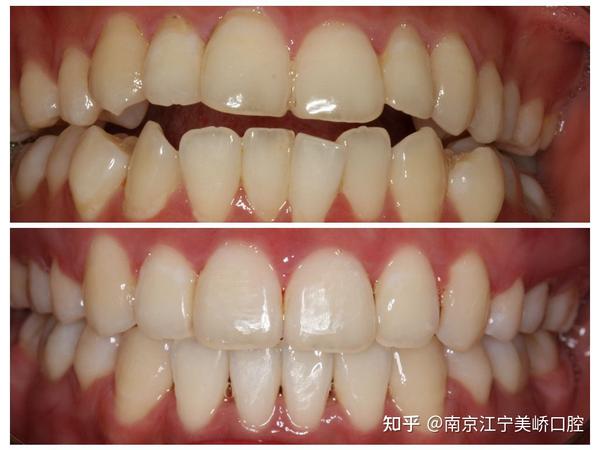 南京牙齿矫正 ——开合矫正 - 知乎