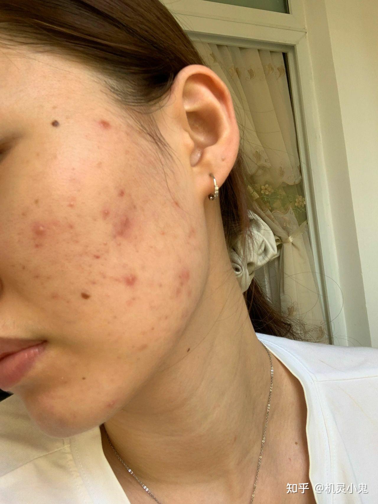 有没有最有效的淡化痘印的产品推荐