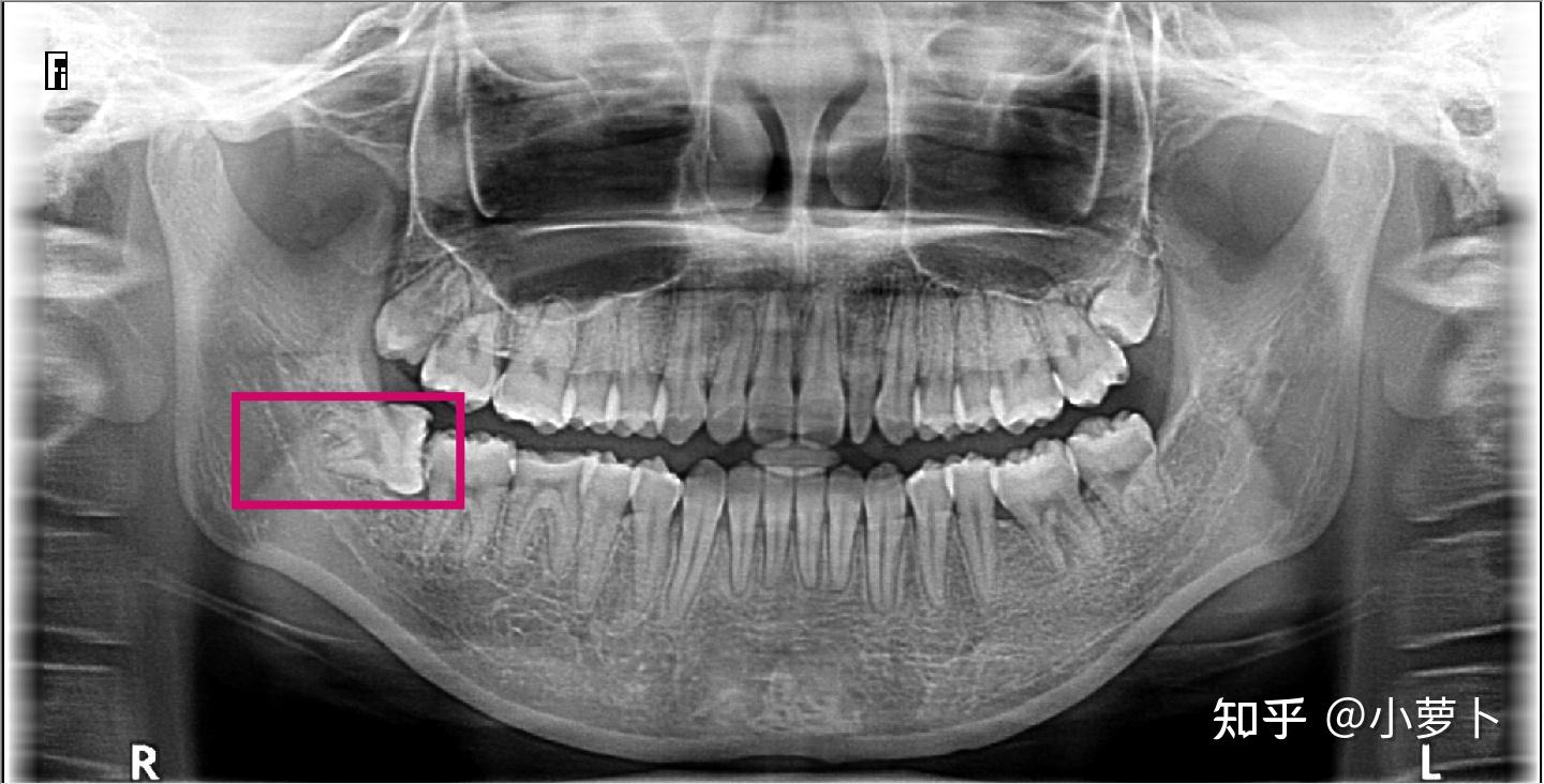 福建医科大学附属口腔医院拔智齿