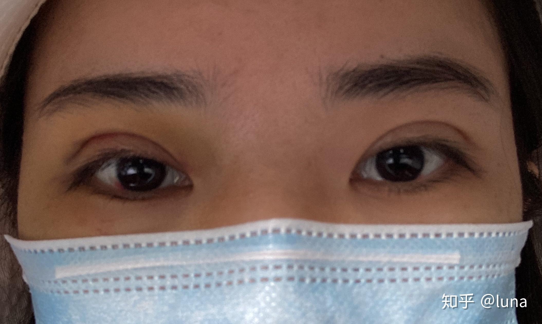 青岛做双眼皮手术哪里好一些或者好的医生？ - 知乎