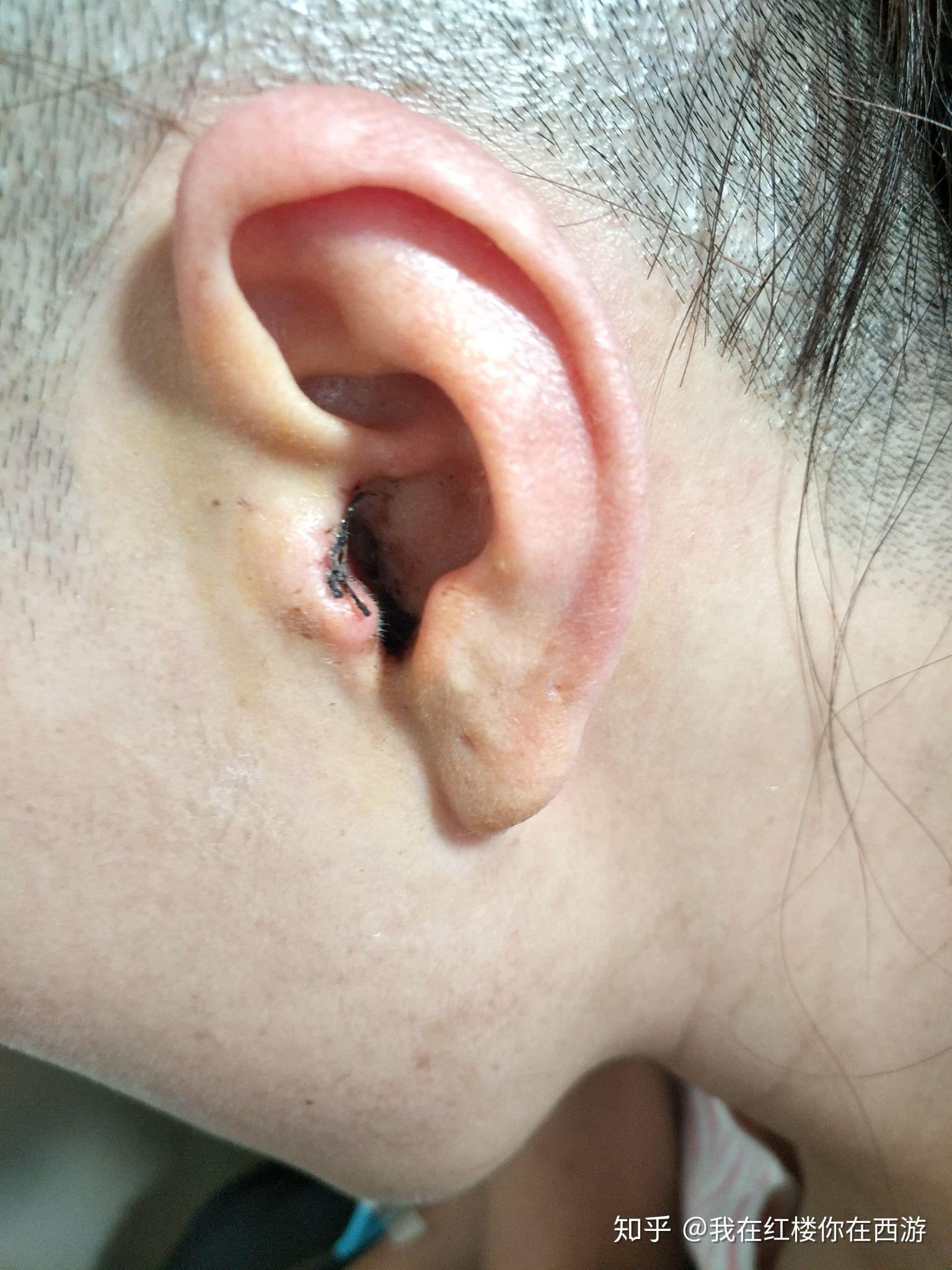 中耳炎引起鼓膜穿孔,做了鼓膜修补术