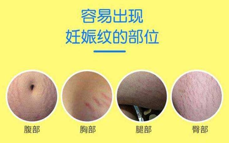 宝妈对抗妊娠纹干货/网红产品测评