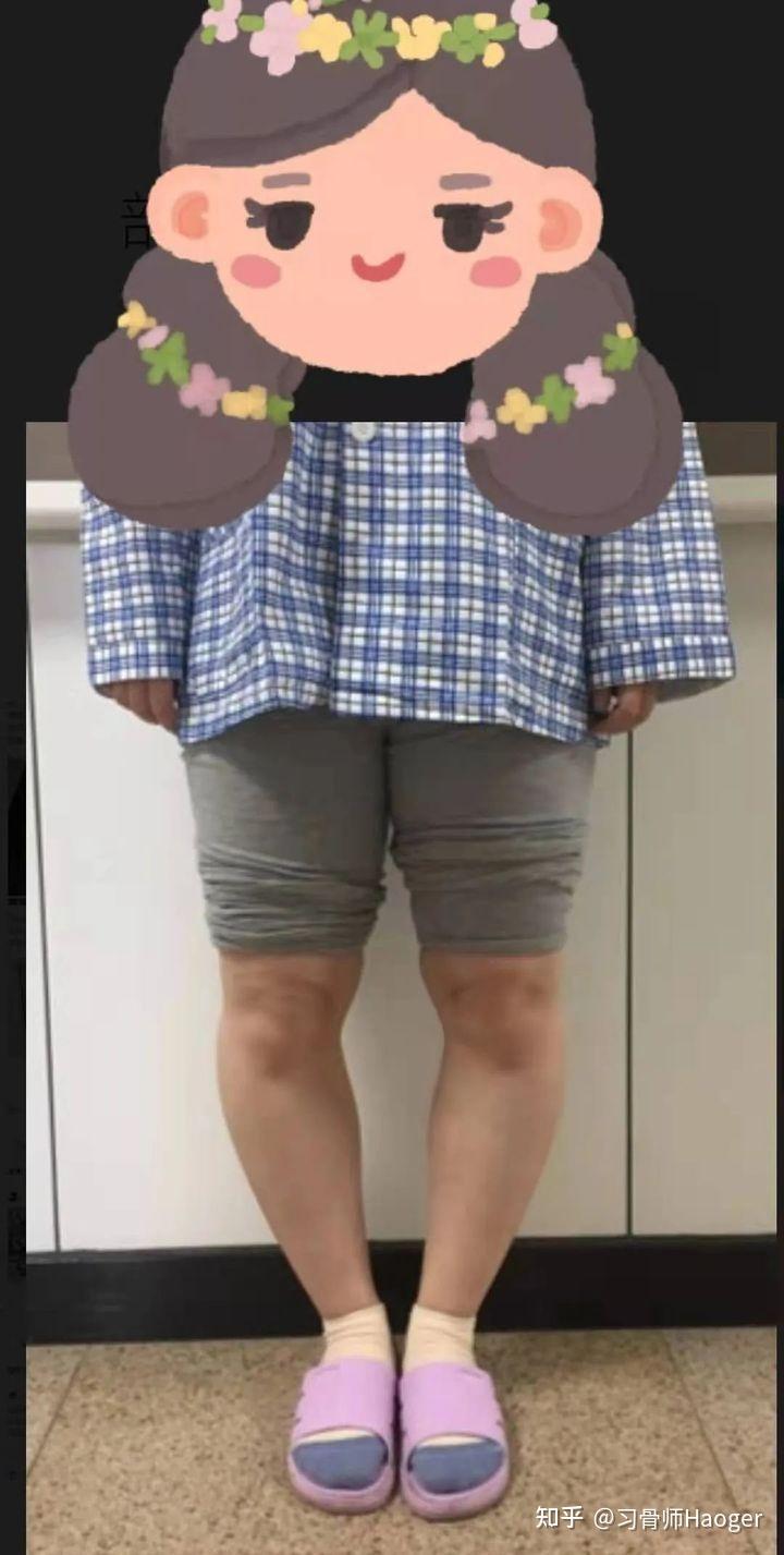 腿型难看怎么办罗圈腿需要矫正吗