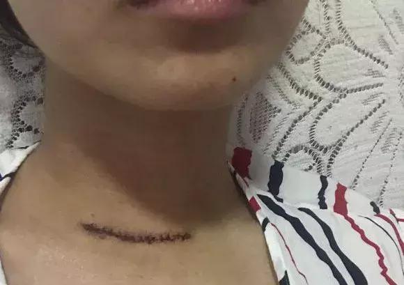 25岁肿瘤医院护士分享甲状腺癌淋巴转移经历坚强面对勇敢生活