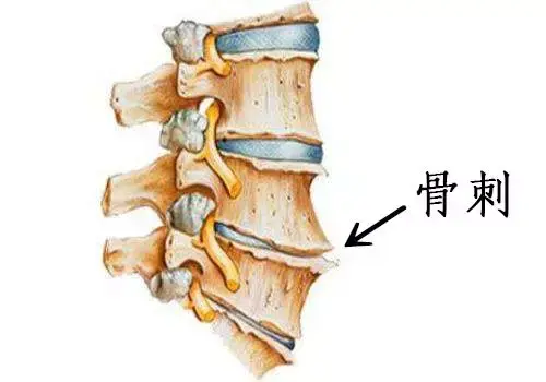 骨刺就是骨质增生,是人体的一种自我保护反应.