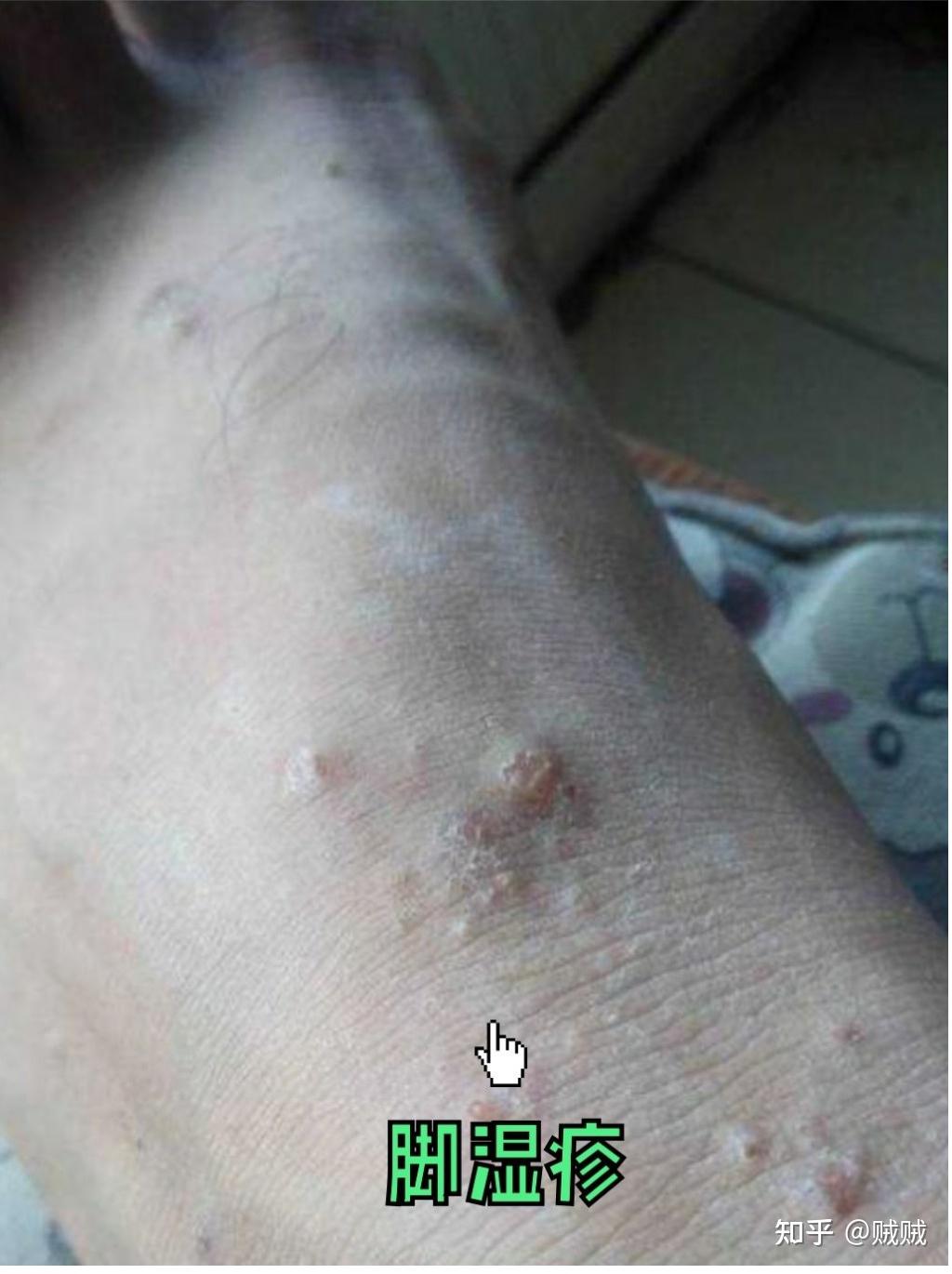 脚趾湿疹与脚气区别图图片