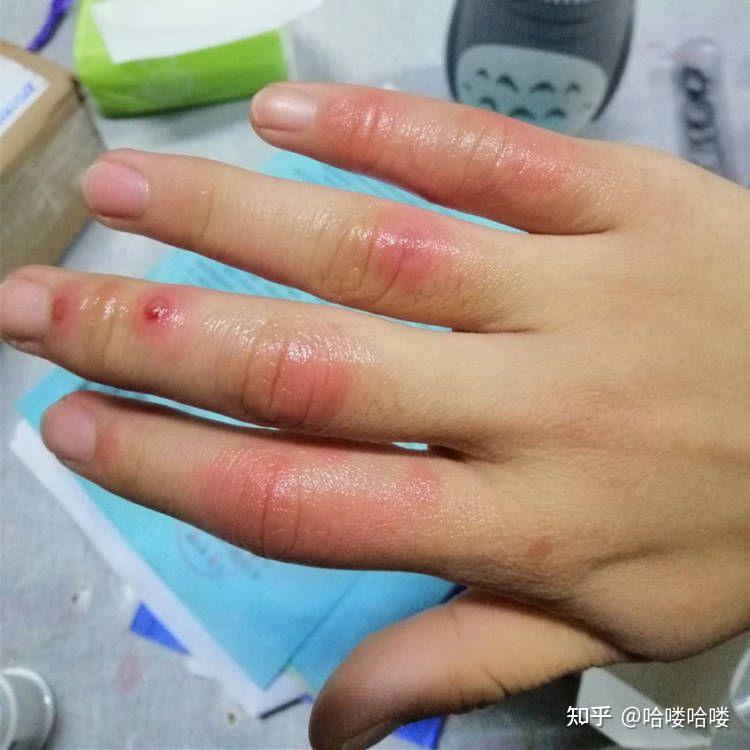 冻疮怎么好得快?既简单又实用的方法分析!!! - 知乎
