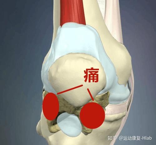 超全膝关节疼痛地图