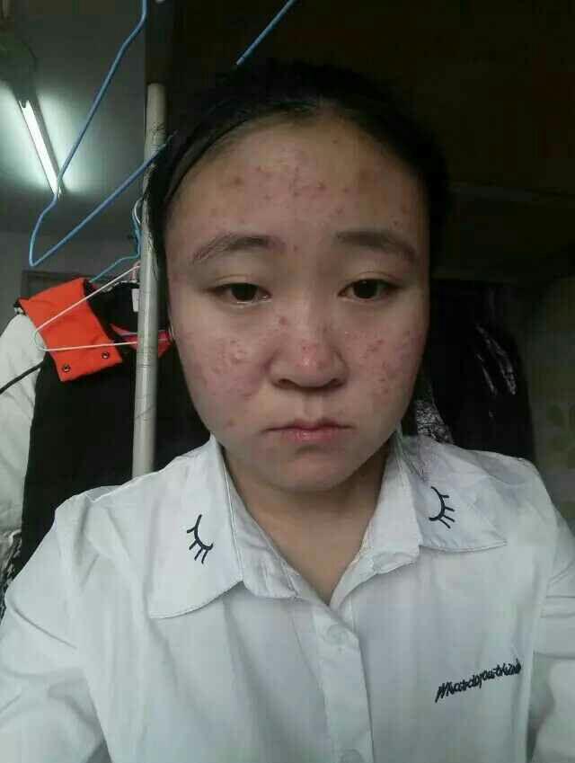 满脸痘痘很自卑,怎么办? - 知乎