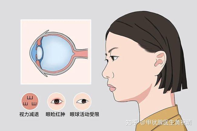 眼睛畏光、流泪、有异物感？注意！你可能是患上了这种疾病！ - 知乎