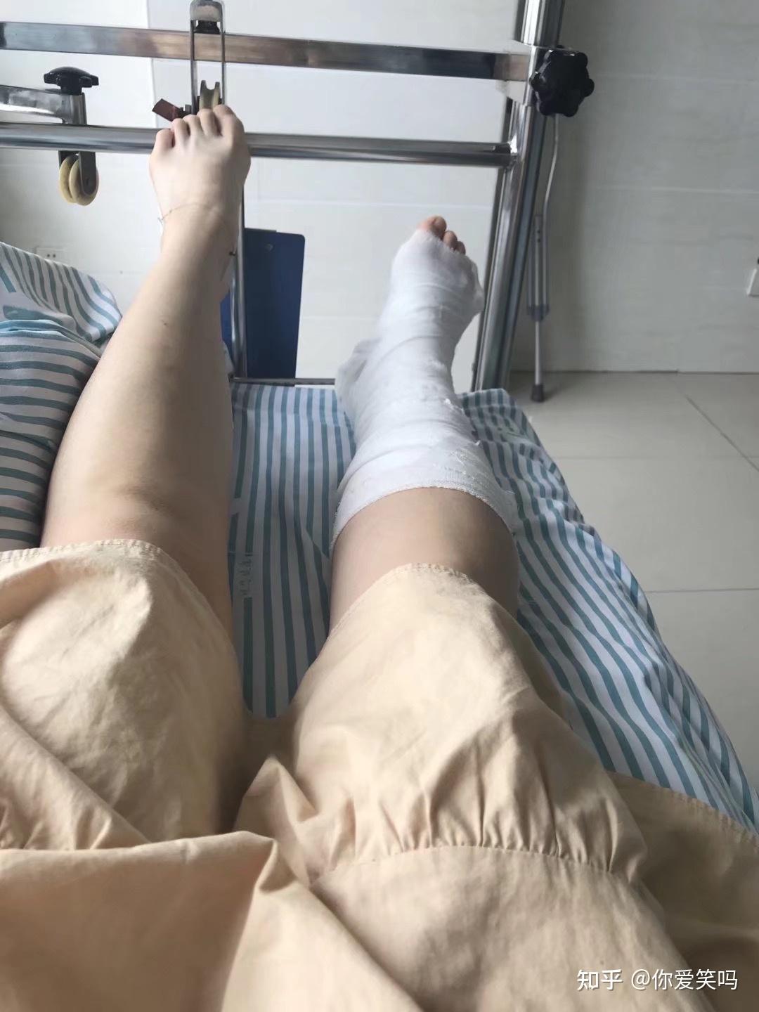 关于我的三踝骨折韧带撕裂