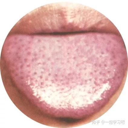 史上最全!高清舌诊图谱,看舌头知健康,值得收藏 - 知乎